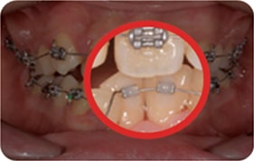 Orthodontic treatment photos