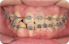 Orthodontic treatment photos