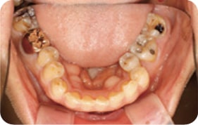 Oral photo with uneven teeth