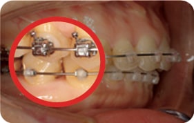 Orthodontic treatment photos