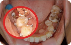 Orthodontic treatment photos