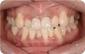 Oral photo with uneven teeth