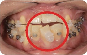 Oral photo with uneven teeth
