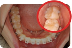 Oral photo with uneven teeth