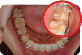 Oral photo with uneven teeth